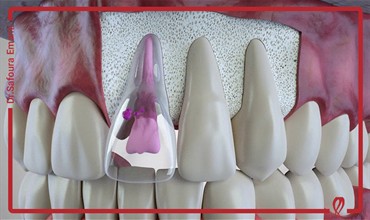 بررسی پاتوفیزیولوژی و درمان تحلیل ریشه خارجی پس از ضربه های دندانی